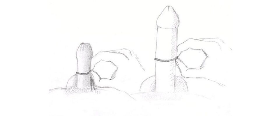 Messung der Penisdicke